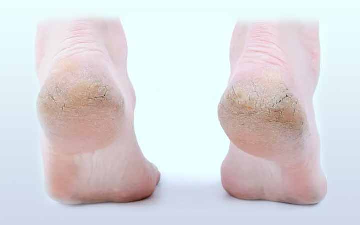 আসছে শীতে পা ফাটার সমস্যা থেকে মুক্তি লাভের উপায়